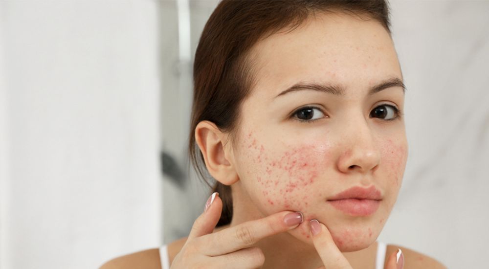 best makeup for pitted acne scars