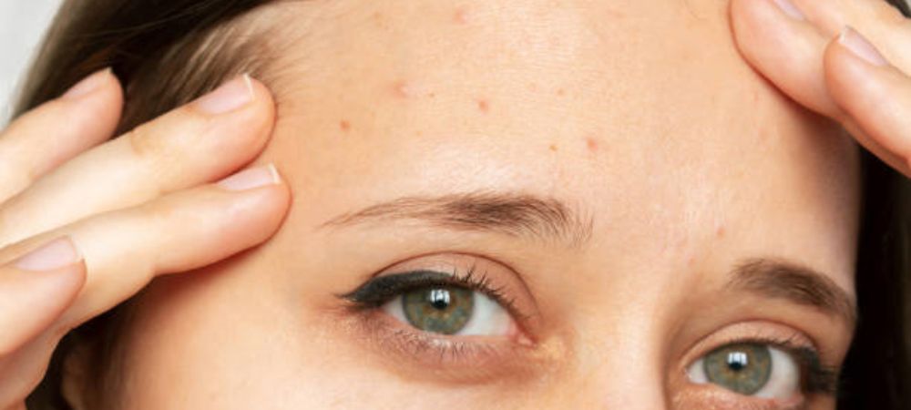 what causes forehead acne